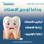 زراعة الاسنان تركيبات الاسنان